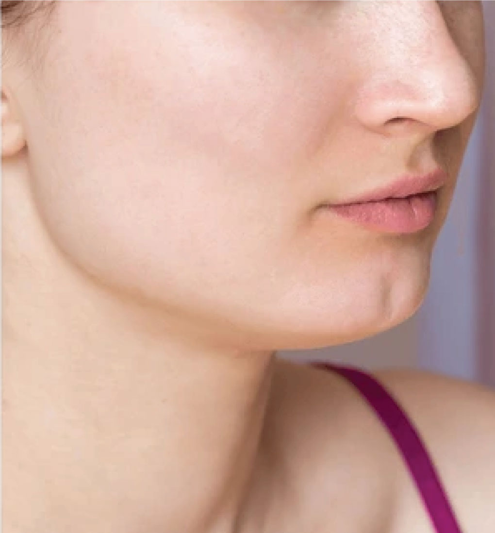 After-Acne Treatment 