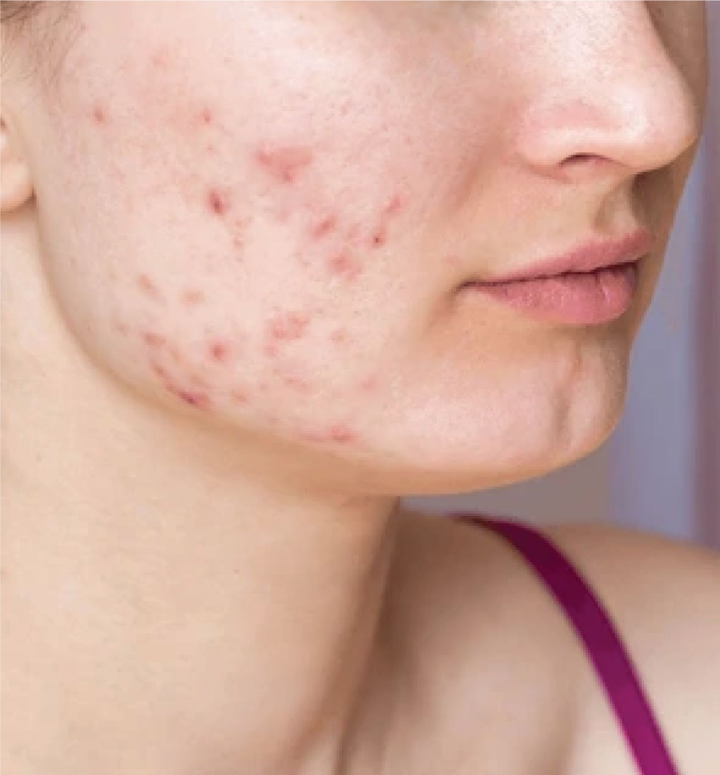 Before-Acne Treatment 